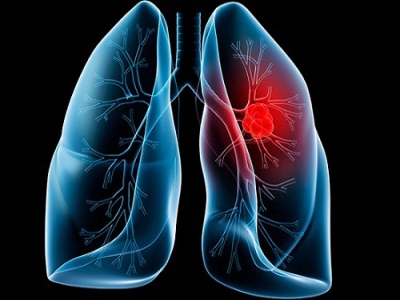 Chẩn đoán sớm ung thư phổi