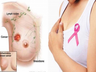 Dấu hiệu cảnh báo ung thư vú, mọi chị em nên biết