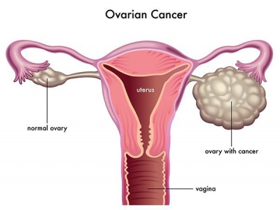 Ung thư buồng trứng và những điều cần biết