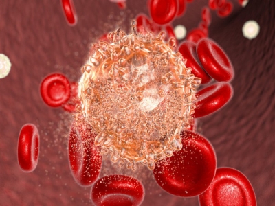 Ung thư máu sống được bao lâu?