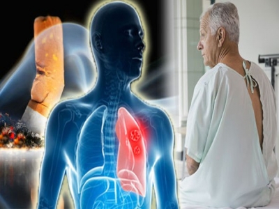 Tiết lộ 5 sự thật ít biết về ung thư phổi