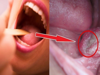 Biểu hiện của ung thư vòm họng