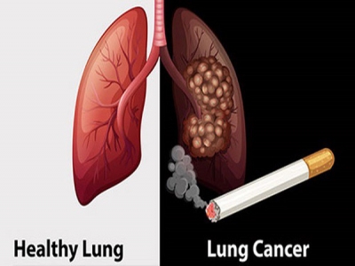 Những bệnh ung thư liên quan tới thuốc lá